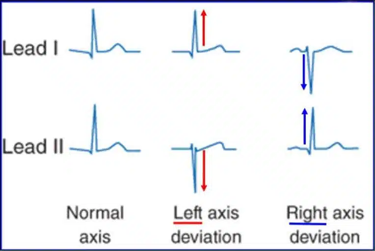ECG Axis Deviation