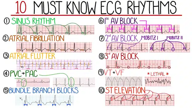 ECG Common Rhythms