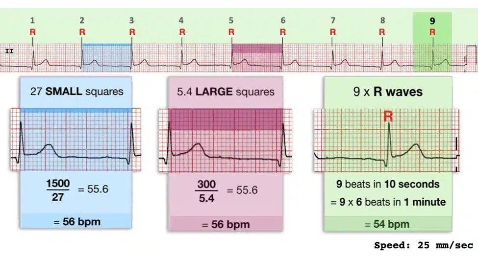 ECG How to Calculate Heart Rate