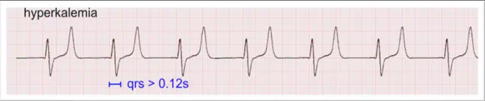 Hyperkalaemia ECG