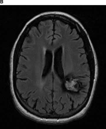 MRI Brain Palinopsia