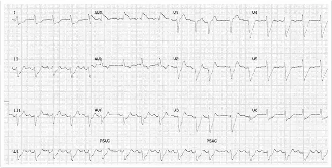 Myocardial Infarction ECG