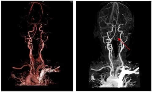 Palinopsia imaging 1