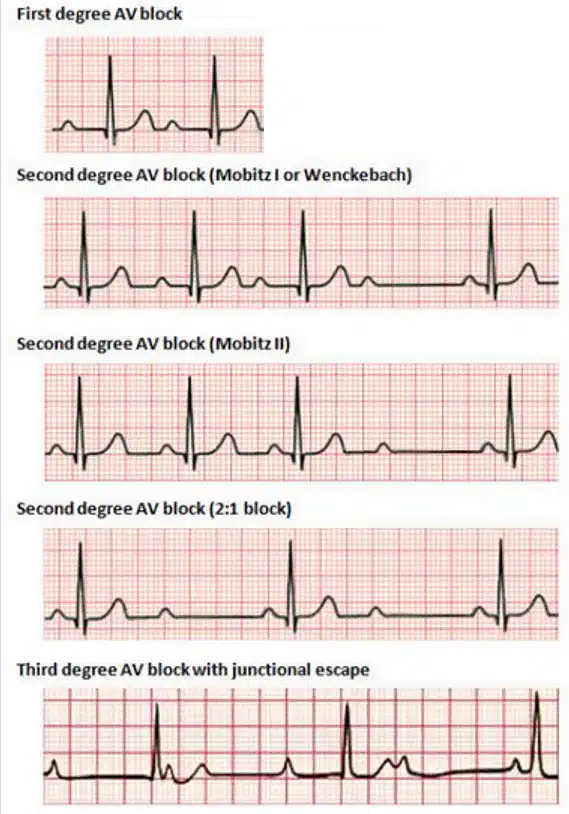 Types of Heart Blocks