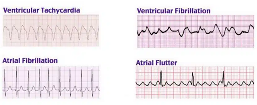 VT vs VF vs AF vs Atrial Flutter